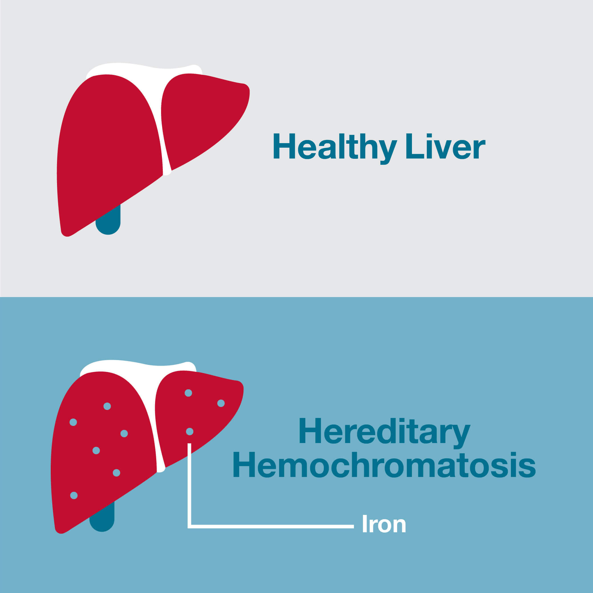 Hereditary Hemochromatosis Carter BloodCare